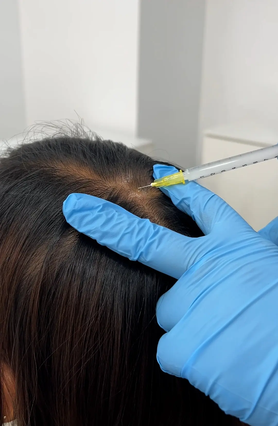 Mesoterapia Capilar